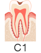 虫歯　C1